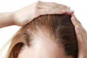 Alopecia por estrés: síntomas, causas y cómo solucionarlo